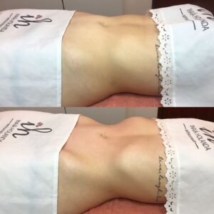 Intradermoterapia-1