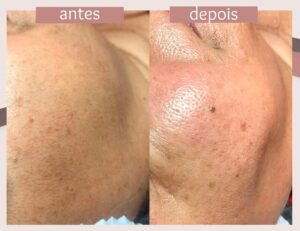 Limpeza-de-pele+Dermaplaning-1