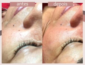 Limpeza-de-pele+Dermaplaning-2