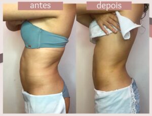 Mesoterapia-12