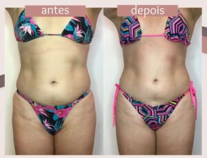 Mesoterapia-5